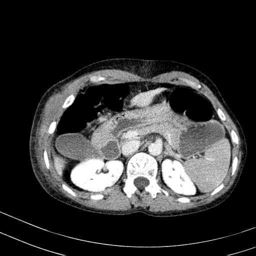 Abdominal wall hematoma with active bleeding (Radiopaedia 83915-99117 Axial C+ portal venous phase 8).jpg