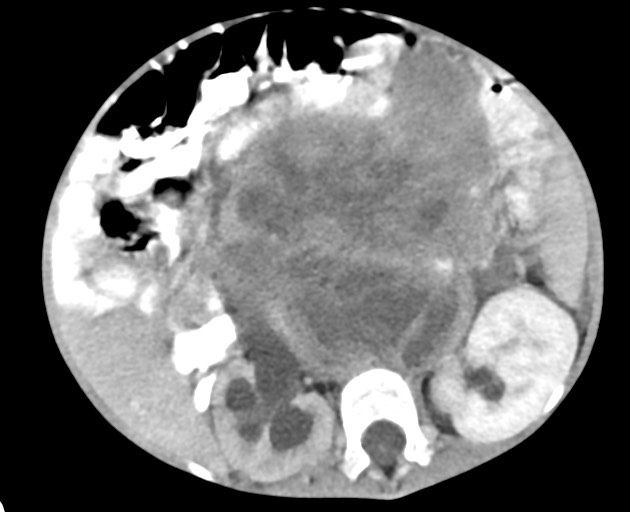 File:Abdominopelvic rhabdomyosarcoma (Radiopaedia 78356-90984 Axial C+ portal venous phase 81).jpg