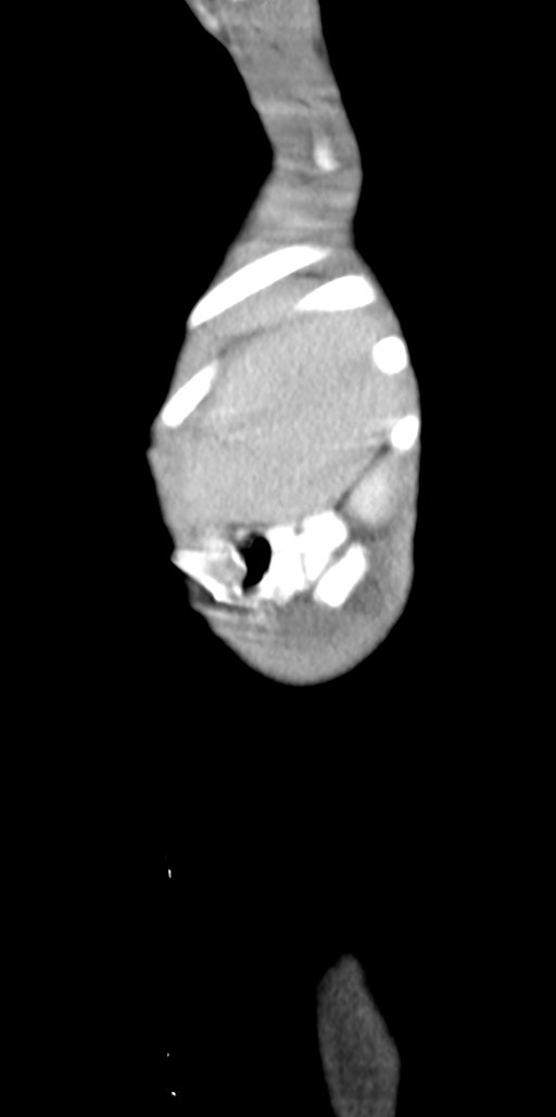 Abdominopelvic rhabdomyosarcoma (Radiopaedia 78356-90984 Sagittal C+ portal venous phase 10).jpg