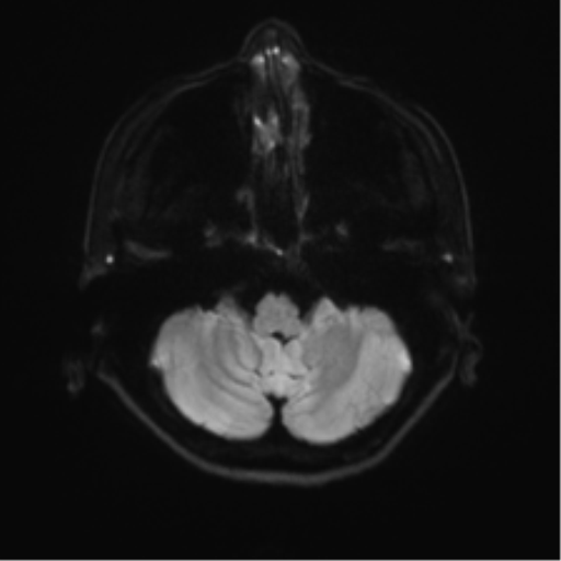 Abducens nerve palsy (Radiopaedia 51069-56648 Axial DWI 31).png