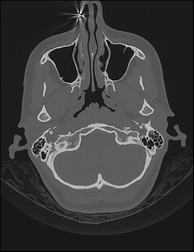 Aberrant right internal carotid artery (Radiopaedia 65191-74198 Axial non-contrast 17).jpg