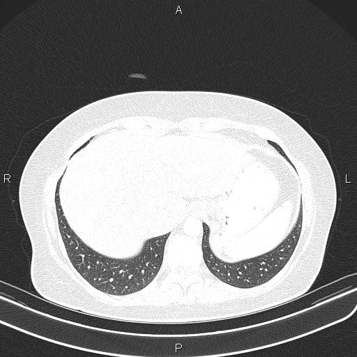 Aberrant right subclavian artery (Radiopaedia 87334-103629 Axial lung window 57).jpg