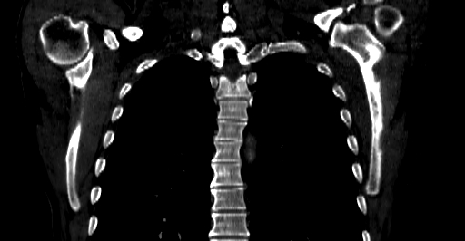 Accesory rib joint (Radiopaedia 71987-82452 Coronal bone window 34).jpg