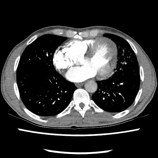Accessory left horizontal fissure with lingular pneumonia (Radiopaedia 53763-59843 Axial C+ CTPA 63).jpg