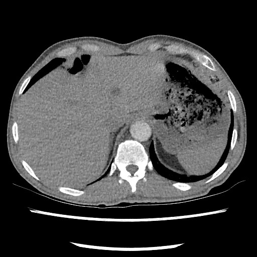 Accessory left horizontal fissure with lingular pneumonia (Radiopaedia 53763-59843 Axial C+ CTPA 81).jpg