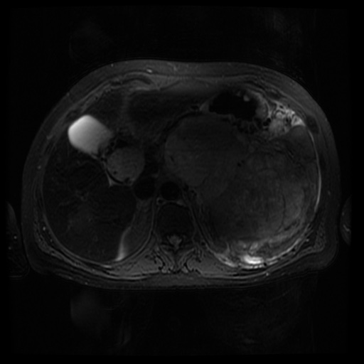 Acinar cell carcinoma of the pancreas (Radiopaedia 75442-86668 Axial T2 fat sat 27).jpg