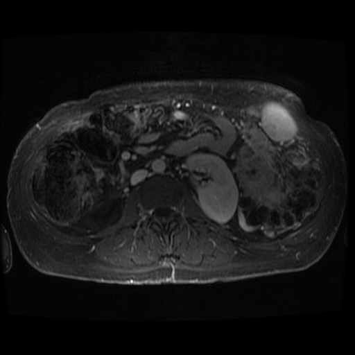 Acinar cell carcinoma of the pancreas (Radiopaedia 75442-86668 D 16).jpg