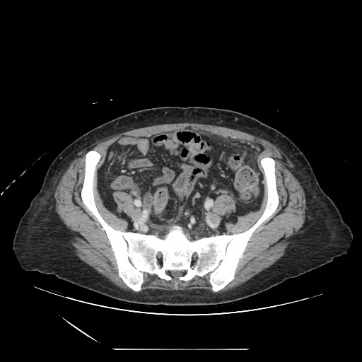 File:Acinar cell carcinoma of the pancreas (Radiopaedia 75442-86669 Axial C+ portal venous phase 111).jpg