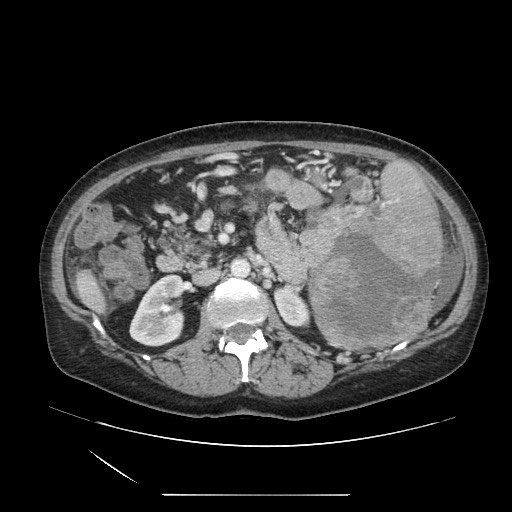 File:Acinar cell carcinoma of the pancreas (Radiopaedia 75442-86669 Axial C+ portal venous phase 60).jpg
