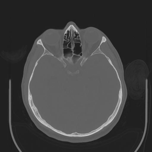 File:Acoustic schwannoma (Radiopaedia 29488-29982 AXIAL BONE THICK non-contrast 19).jpg