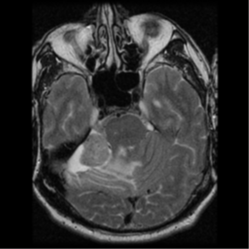 File:Acoustic schwannoma (Radiopaedia 39170-41387 Axial T2 11).png