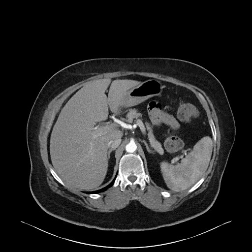 Acromioclavicular joint cyst (Radiopaedia 58455-65610 Axial C+ arterial phase 104).jpg