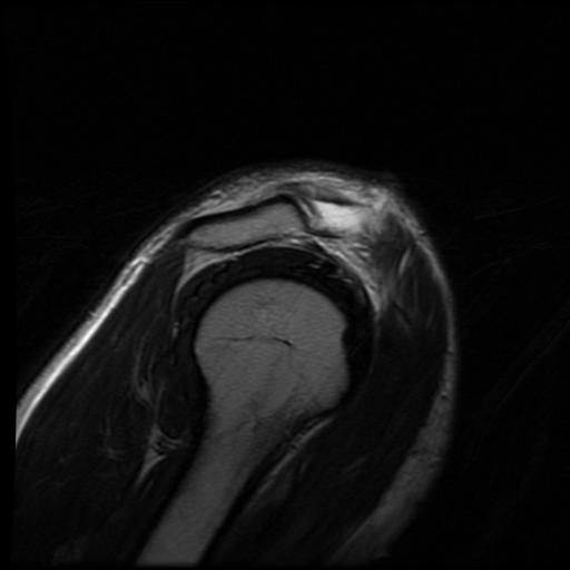 File:Acromioclavicular joint dislocation (Radiopaedia 14218-14076 Sagittal T2 4).jpg