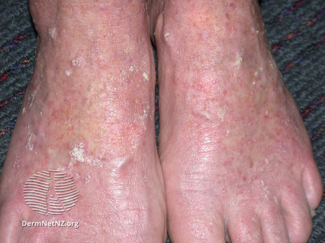 File:Actinic keratoses (DermNet NZ lesions-sk2).jpg