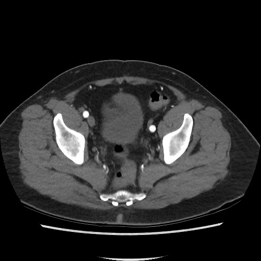Active colonic bleed on CT (Radiopaedia 49765-55025 Axial C+ arterial phase 72).jpg