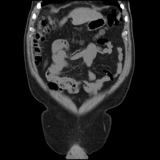 Active colonic bleed on CT (Radiopaedia 49765-55025 Coronal non-contrast 14).jpg