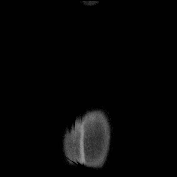 Active colonic bleed on CT (Radiopaedia 49765-55025 Coronal non-contrast 57).jpg