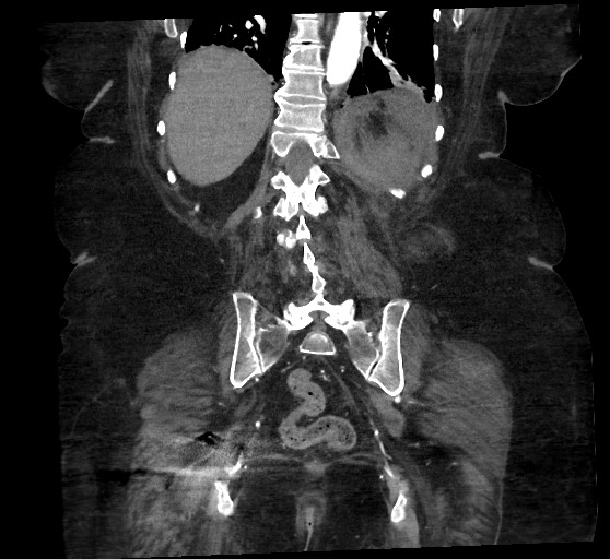 Active renal extravasation with large subcapsular and retroperitoneal hemorrhage (Radiopaedia 60975-68796 Coronal C+ arterial phase 115).jpg