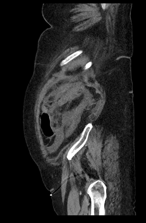 Active renal extravasation with large subcapsular and retroperitoneal hemorrhage (Radiopaedia 60975-68796 Sagittal C+ portal venous phase 51).jpg