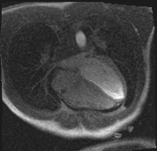 Active right ventricular cardiac sarcoidosis (Radiopaedia 55596-62100 Axial Dynamic perfusion scan MOCO 77).jpg