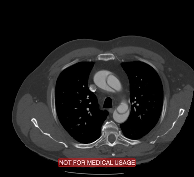 Acute aortic dissection - Stanford type A (Radiopaedia 40661-43285 Axial C+ arterial phase 11).jpg