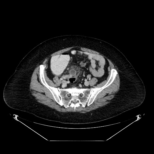 File:Acute appendicitis, heterotaxy syndrome (Radiopaedia 66884-76202 Axial C+ portal venous phase 97).jpg