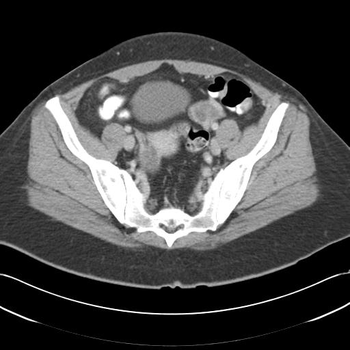 File:Acute appendicitis (Radiopaedia 30297-30934 Axial C+ portal venous phase 65).jpg