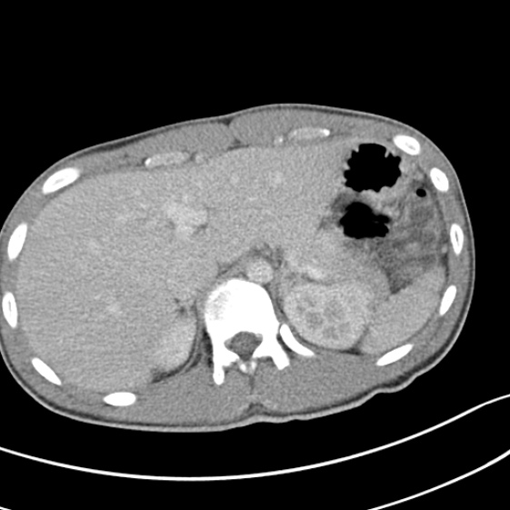 Acute appendicitis (Radiopaedia 32614-33572 Axial C+ portal venous phase 13).jpg