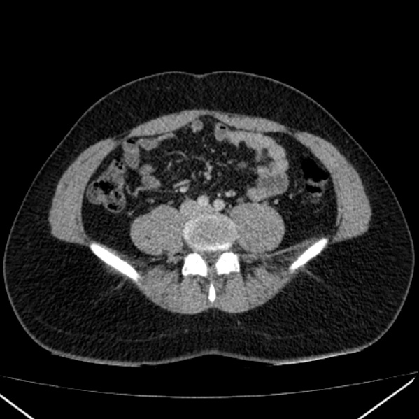 Acute appendicitis (Radiopaedia 38255-40270 Axial C+ portal venous phase 67).jpg