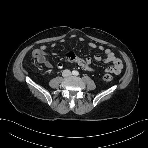 Acute appendicitis - large appendicoliths (Radiopaedia 61805-69820 Axial C+ portal venous phase 78).jpg