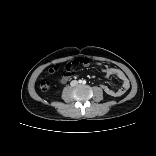Acute appendicitis and COVID 19 pneumonia (Radiopaedia 76604-88380 Axial C+ portal venous phase 46).jpg