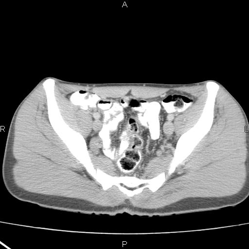 File:Acute appendicitis with CT arrowhead sign (Radiopaedia 21474-21411 Axial C+ portal venous phase 33).jpg