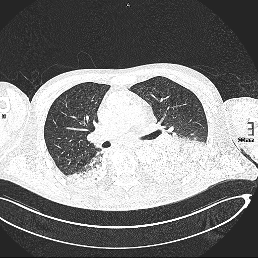 File:Acute aspiration pneumonitis (Radiopaedia 55642-62166 Axial lung window 74).jpg