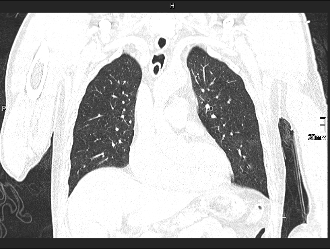 File:Acute aspiration pneumonitis (Radiopaedia 55642-62166 Coronal lung window 38).jpg