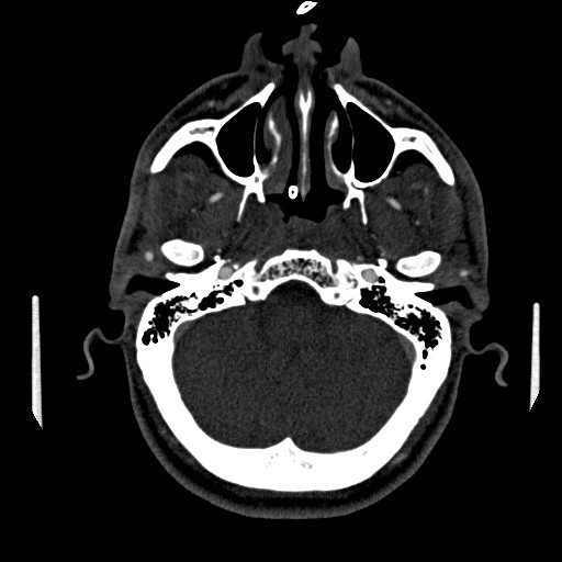 Acute basilar artery occlusion (Radiopaedia 43582-46985 Axial C+ arterial phase 81).jpg