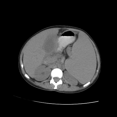 File:Acute calculous cholecystitis in patient with osteopetrosis (Radiopaedia 77871-90159 Axial non-contrast 37).jpg