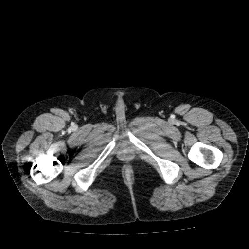File:Acute cholecystitis and incidental left sided IVC (Radiopaedia 49352-54459 Axial C+ portal venous phase 167).jpg
