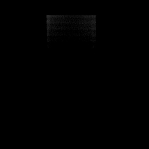 Acute cholecystitis with tensile fundus sign (Radiopaedia 71394-81723 Coronal non-contrast 156).jpg