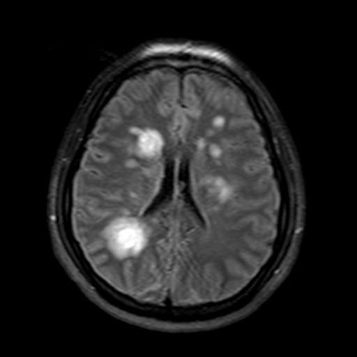 File:Acute disseminated encephalomyelitis (ADEM)- Anti-NMDA receptor encephalitis (Radiopaedia 54920-61198 Axial FLAIR post-GAD 15).png