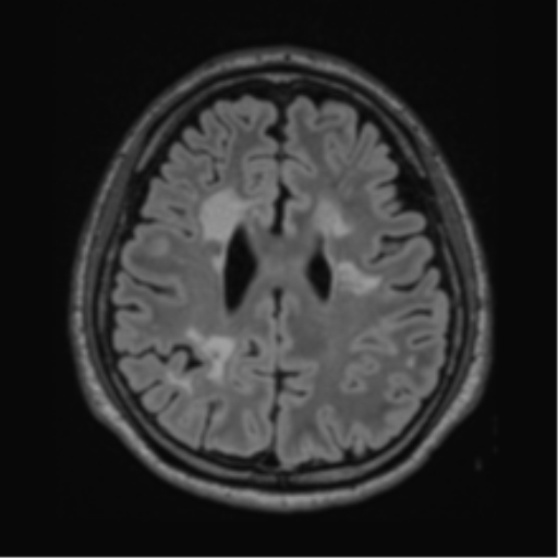 File:Acute disseminated encephalomyelitis (ADEM)- Anti-NMDA receptor encephalitis (Radiopaedia 54920-61201 Axial FLAIR 47).png