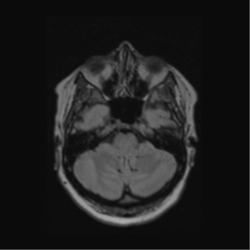Acute disseminated encephalomyelitis (ADEM) (Radiopaedia 38073-40065 Axial FLAIR 12).png