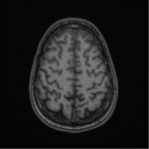 Acute disseminated encephalomyelitis (ADEM) (Radiopaedia 65319-74349 Axial T1 54).png