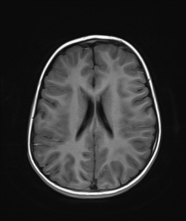 File:Acute disseminating encephalomyelitis with bilateral optic neuritis (Radiopaedia 79676-92886 Axial T1 16).jpg