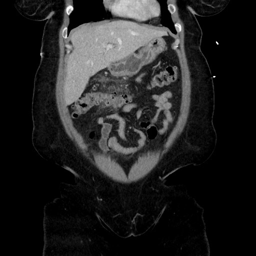 Acute diverticulitis - transverse colon (Radiopaedia 87063-103327 Coronal C+ portal venous phase 55).jpg