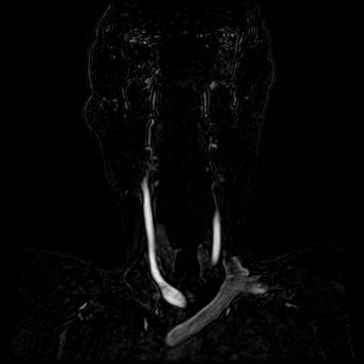 Acute internal carotid artery dissection (Radiopaedia 53541-59632 Coronal MRA 70).jpg