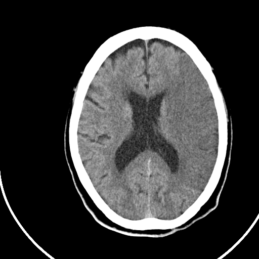 File:Acute ischemic stroke- dense MCA sign (Radiopaedia 45310).Jpg