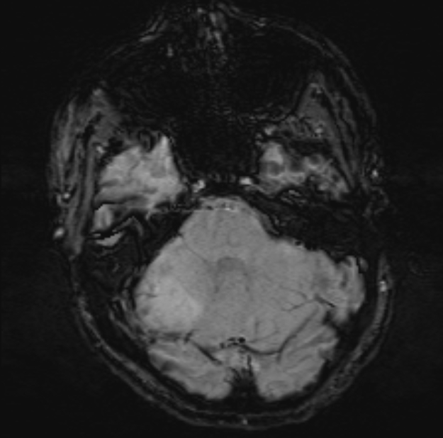 Acute ischemic stroke - posterior circulation territory (Radiopaedia 77670-89880 Axial SWI 16).jpg