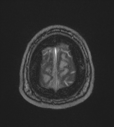 Acute left middle cerebral artery territory infarct with clot retrieval (Radiopaedia 47732-52433 Axial MRA 65).png