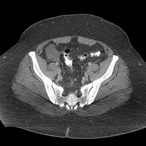 Acute mesenteric venous ischemia (Radiopaedia 46041-50383 Axial C+ portal venous phase 114).jpg