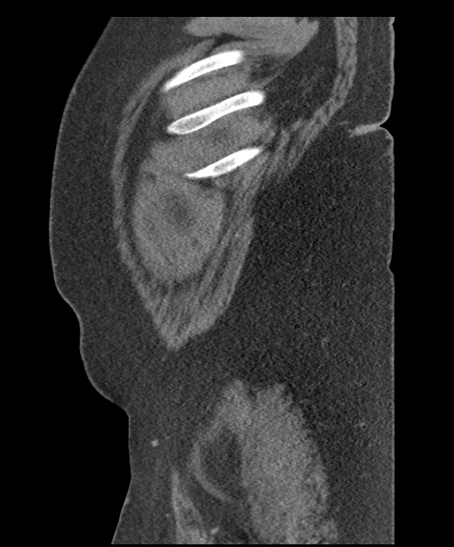 Acute mesenteric venous ischemia (Radiopaedia 46041-50383 Sagittal C+ portal venous phase 7).jpg